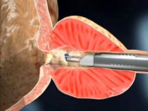 Plazma Kinetik TUR Ameliyatı