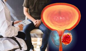 Prostat Büyümesi Kanserine Dönüşür Mü?