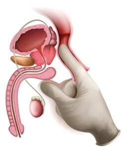 Prostat Muayenesi Ne Zaman Yapılmalı