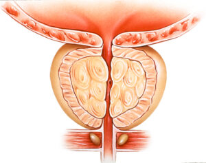 Benign Prostat Hiperplazisi (BPH) Nedir?