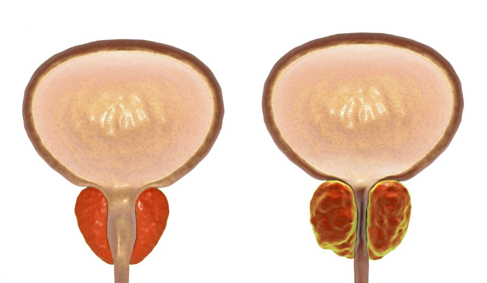 Prostatit Belirtileri
