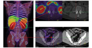 Prostat Kanseri Evrelemesinde PSMA PET-CT