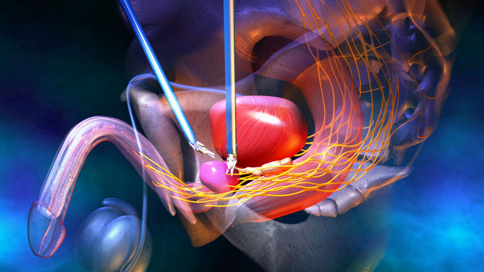 prostat kanserinde tedavi seçenekleri