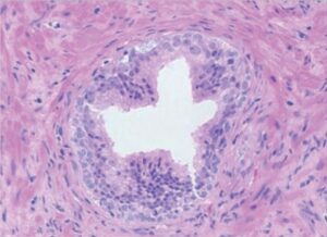 Prostatik İntraepitelyal Neoplazi-PIN