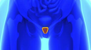 perineal-radikal-prostatektomi