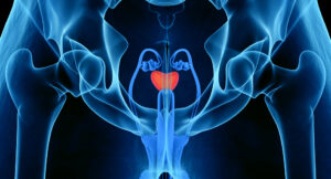 Prostat kanserinde prostat alınır mı?