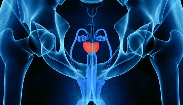 Prostat kanserinde prostat alınır mı?