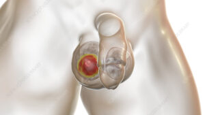 Evre 1 Testis Kanseri Tedavisi