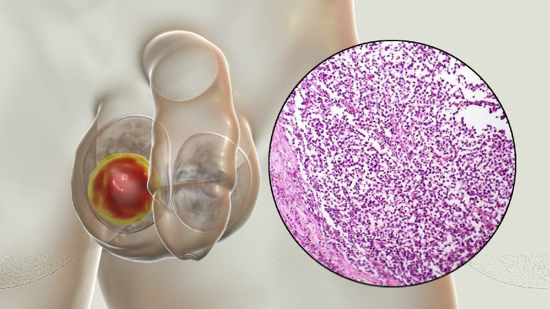 Testis Tümörü Tedavisi