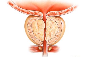 Prostat Büyümesi Nedir?