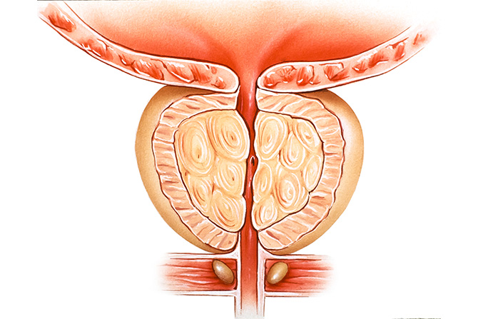 Prostat Büyümesi Nedir?